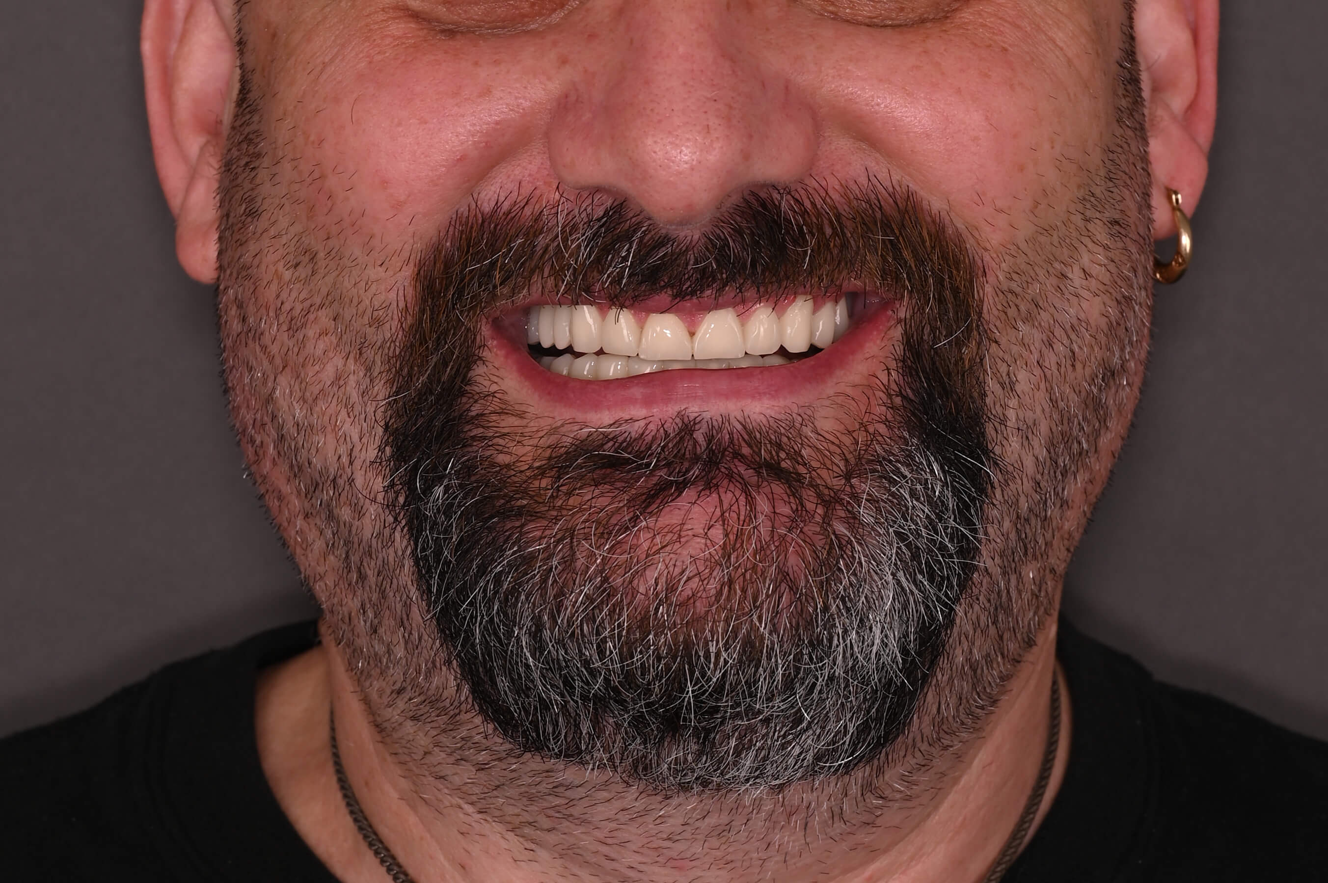 Zâmbet frontal_dupa